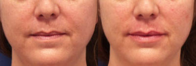 Dermal Fillers before and after photo