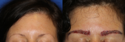 Eyebrow Transplant before and after photo