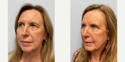 Eyelid Surgery before and after photo