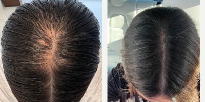 Hair Loss Treatment before and after photo