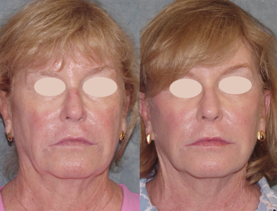 Mini Facelift before and after photo