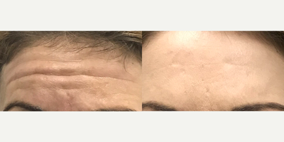 Botox before and after photo