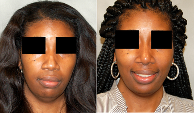 Rhinoplasty before and after photo