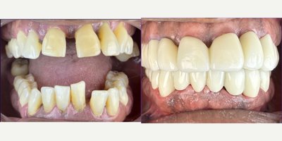 Dental Bridge before and after photo