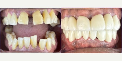 Dental Bridge before and after photo