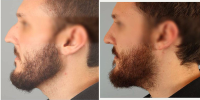 Rhinoplasty before and after photo