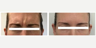 Botox before and after photo
