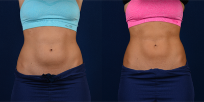 CoolSculpting before and after photo