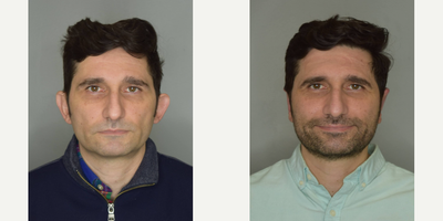 Ear Surgery before and after photo