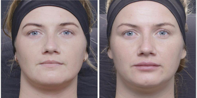 Lip Fillers before and after photo