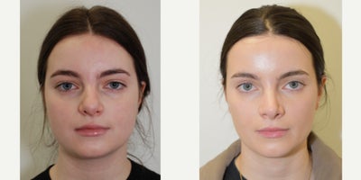 Revision Rhinoplasty before and after photo