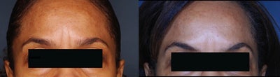 Botox before and after photo