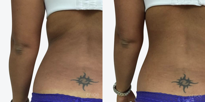 CoolSculpting before and after photo