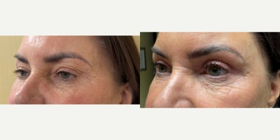 Eyelid Surgery before and after photo