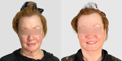 Facelift before and after photo