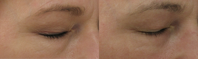 Fraxel Repair before and after photo