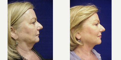 Kybella before and after photo