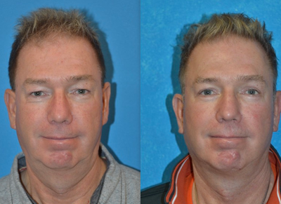 Neck Lift before and after photo