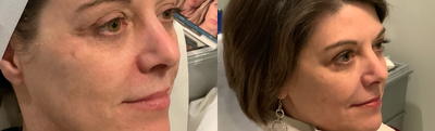 Restylane Lyft before and after photo