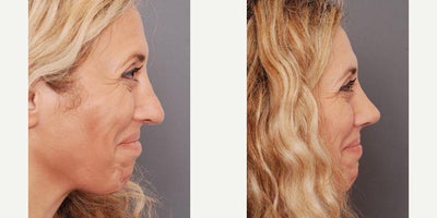 Rhinoplasty before and after photo