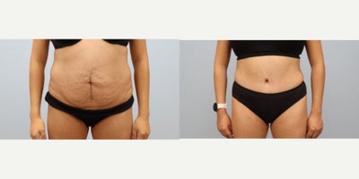 Tummy Tuck before and after photo