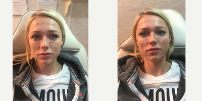 Voluma before and after photo