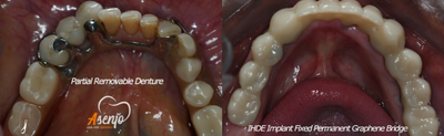 All-on-4 Dental Implants before and after photo