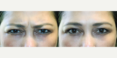 Botox before and after photo