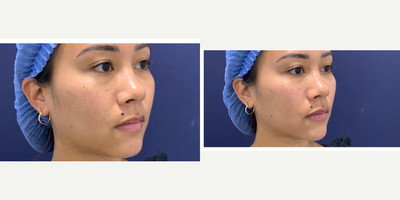 Dermal Fillers before and after photo