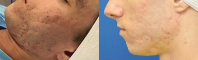 PRP Injections before and after photo