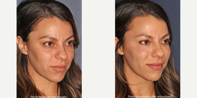 Restylane before and after photo