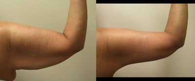 Arm Lift before and after photo