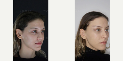 Cheek Lift before and after photo