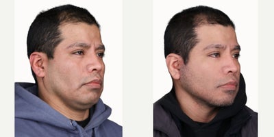 Facelift before and after photo