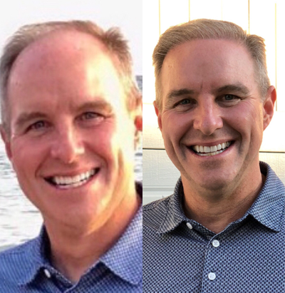 Hair Transplant before and after photo