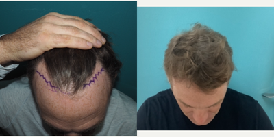 Hair Transplant before and after photo