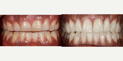 Porcelain Veneers before and after photo