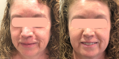 before and after image