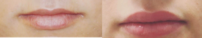Volbella before and after photo