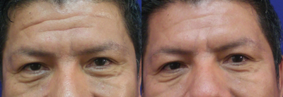 Botox before and after photo