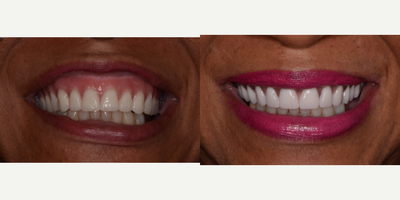 Dental Implants before and after photo