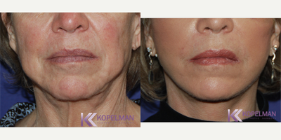 Facelift before and after photo