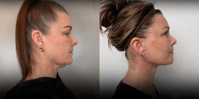 Facelift before and after photo