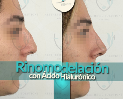 Belotero before and after photo