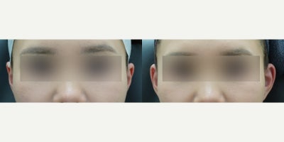 Dermal Fillers before and after photo