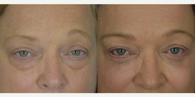 Eyelid Surgery before and after photo