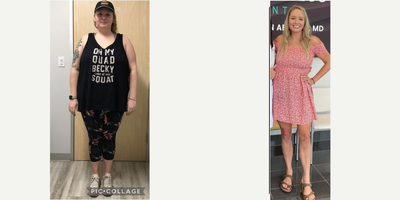 Gastric Sleeve Surgery before and after photo