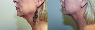 Kybella before and after photo