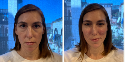 Restylane before and after photo