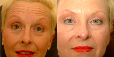 Botox before and after photo